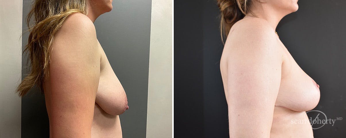 Breast Lift Before & After Gallery - Patient 301556 - Image 3