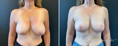 Breast Lift Before & After Gallery - Patient 267777 - Image 1
