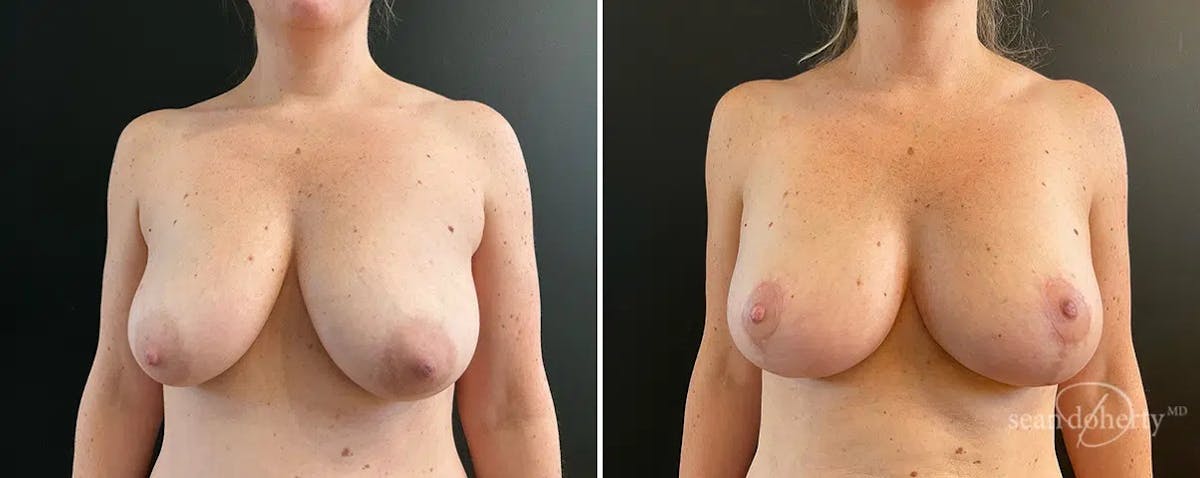 Breast Lift Before & After Gallery - Patient 340973 - Image 1