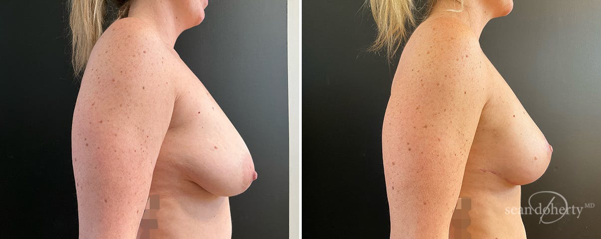 Breast Lift Before & After Gallery - Patient 340973 - Image 3