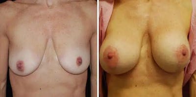Breast Lift with Implants Before & After Gallery - Patient 183679 - Image 1