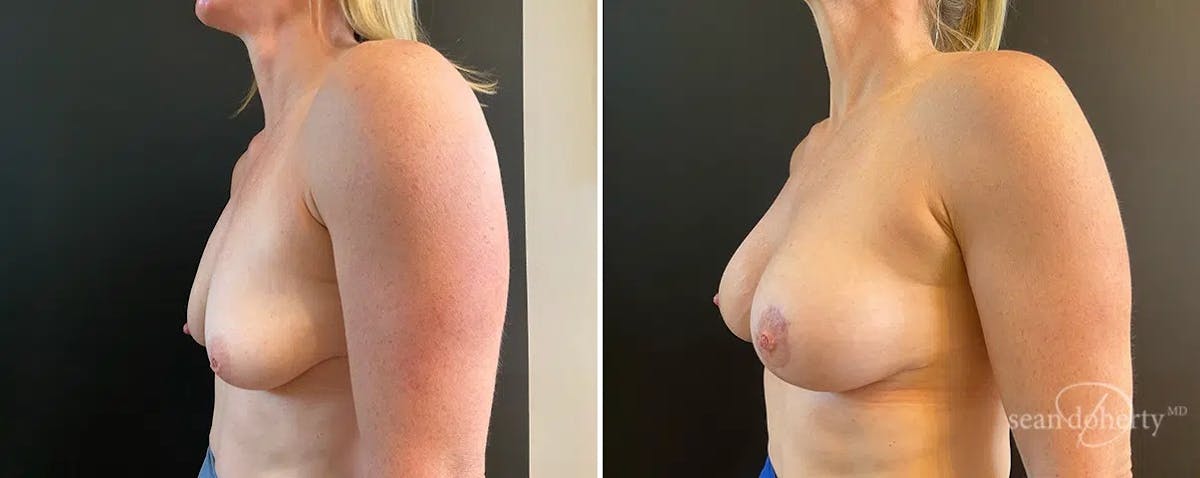 Breast Lift with Implants Before & After Gallery - Patient 869715 - Image 3
