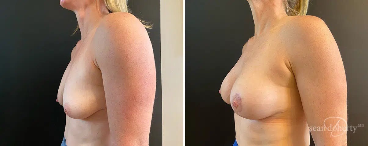 Breast Lift with Implants Before & After Gallery - Patient 869715 - Image 3