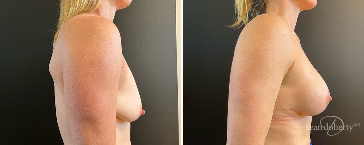 Breast Lift with Implants Before & After Gallery - Patient 869715 - Image 2