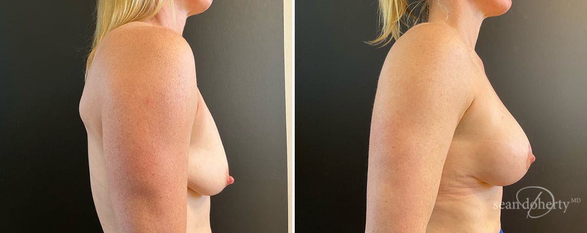 Breast Lift with Implants Before & After Gallery - Patient 869715 - Image 2