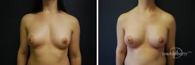 Breast Implant Exchange Before & After Gallery - Patient 130092 - Image 1