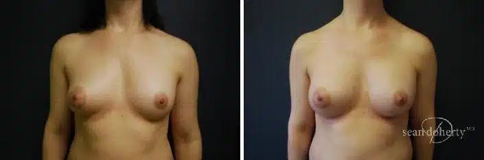 Breast Implant Exchange Before & After Gallery - Patient 130092 - Image 1