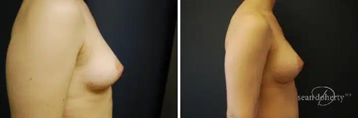 Breast Implant Exchange Before & After Gallery - Patient 130092 - Image 2