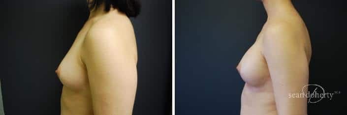 Breast Implant Exchange Before & After Gallery - Patient 130092 - Image 3