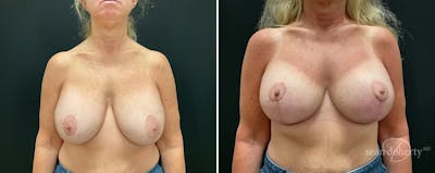 Breast Implant Exchange Before & After Gallery - Patient 294151 - Image 1