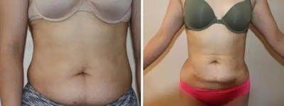 Liposuction and Fat Transfer Before & After Gallery - Patient 264276 - Image 1