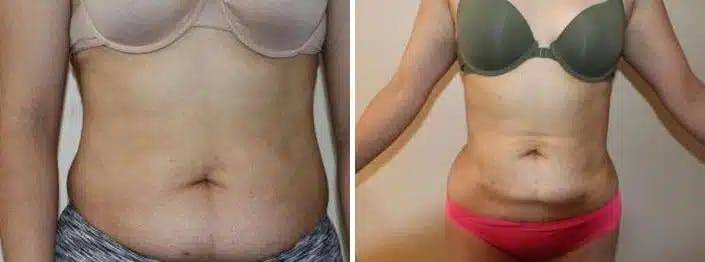 Liposuction and Fat Transfer Before & After Gallery - Patient 264276 - Image 1