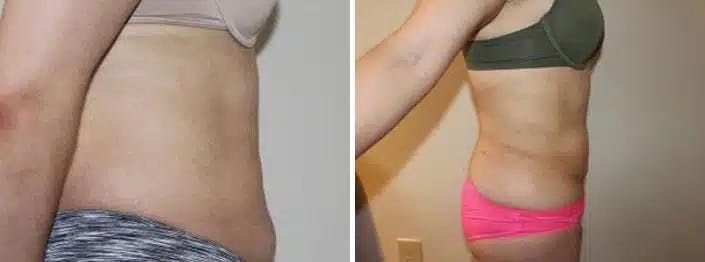 Liposuction and Fat Transfer Before & After Gallery - Patient 264276 - Image 3