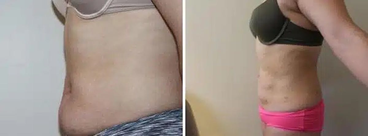 Liposuction and Fat Transfer Before & After Gallery - Patient 264276 - Image 2