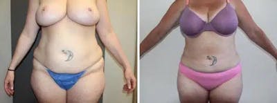 Liposuction and Fat Transfer Before & After Gallery - Patient 204153 - Image 1