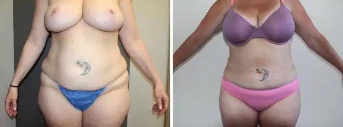 Liposuction and Fat Transfer Before & After Gallery - Patient 204153 - Image 1