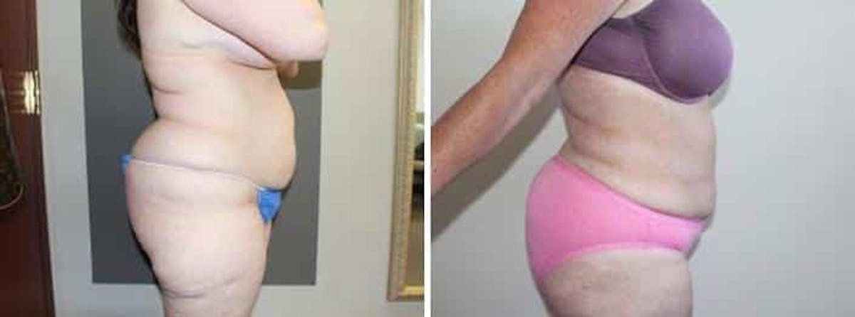 Liposuction and Fat Transfer Before & After Gallery - Patient 204153 - Image 2