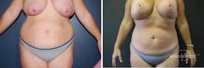Liposuction and Fat Transfer Before & After Gallery - Patient 278477 - Image 1