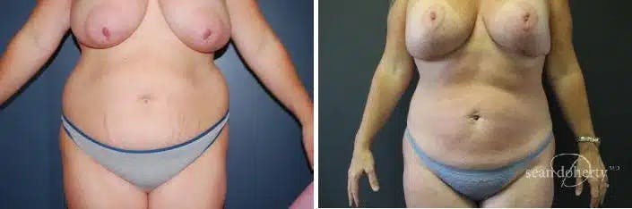 Liposuction and Fat Transfer Before & After Gallery - Patient 278477 - Image 1