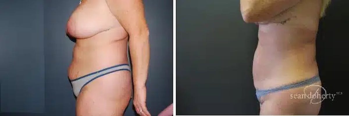 Liposuction and Fat Transfer Before & After Gallery - Patient 278477 - Image 3