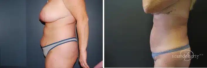 Liposuction and Fat Transfer Before & After Gallery - Patient 278477 - Image 3