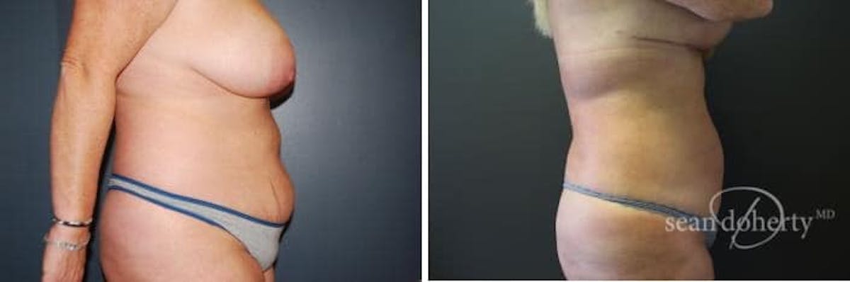 Liposuction and Fat Transfer Before & After Gallery - Patient 278477 - Image 2