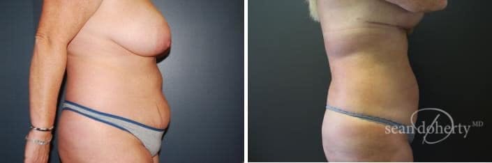 Liposuction and Fat Transfer Before & After Gallery - Patient 278477 - Image 2