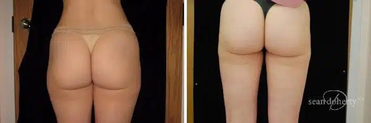 Liposuction and Fat Transfer Before & After Gallery - Patient 237118 - Image 1