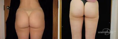 Liposuction and Fat Transfer Before & After Gallery - Patient 237118 - Image 1