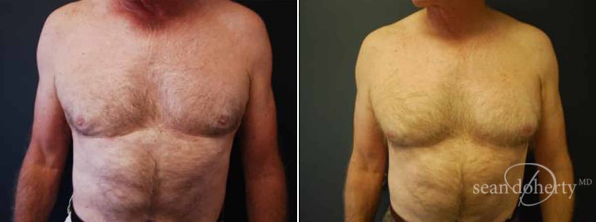 Liposuction and Fat Transfer Before & After Gallery - Patient 292572 - Image 1
