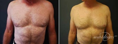 Liposuction and Fat Transfer Before & After Gallery - Patient 292572 - Image 1