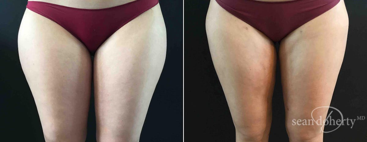 Liposuction and Fat Transfer Before & After Gallery - Patient 374230 - Image 1