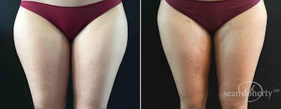 Liposuction and Fat Transfer Before & After Gallery - Patient 374230 - Image 1