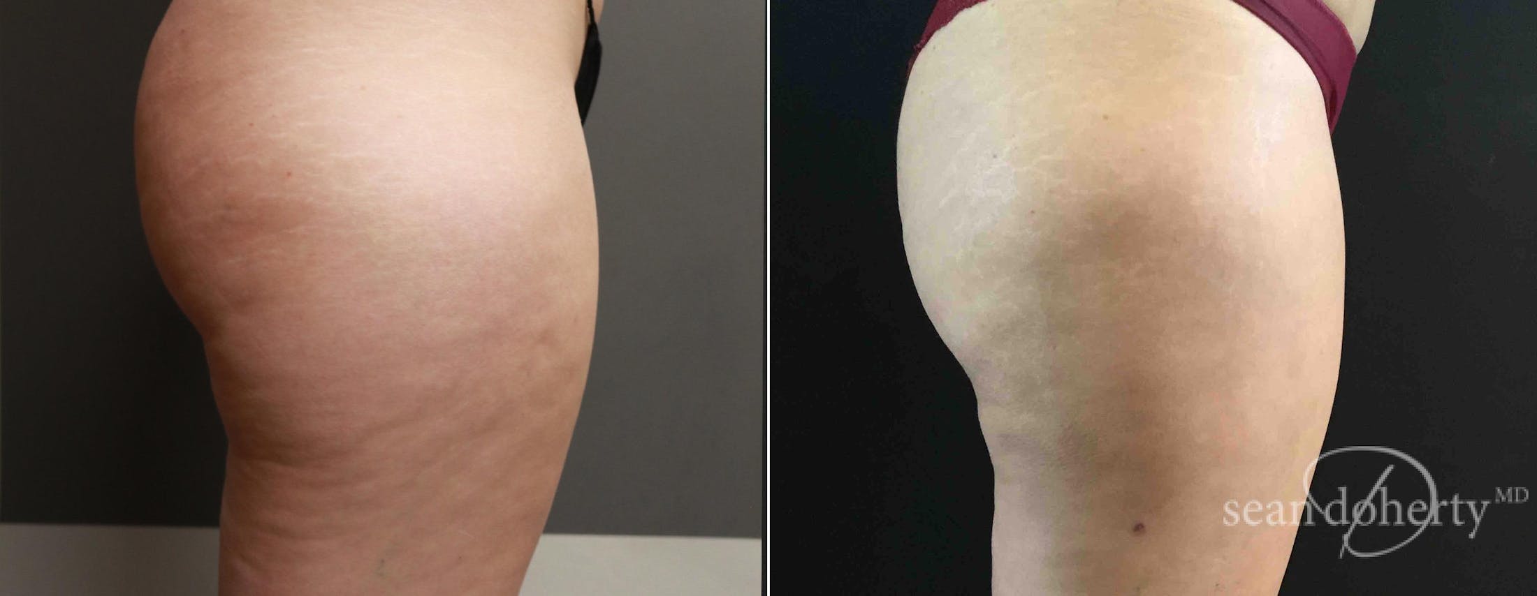 Liposuction and Fat Transfer Before & After Gallery - Patient 374230 - Image 2
