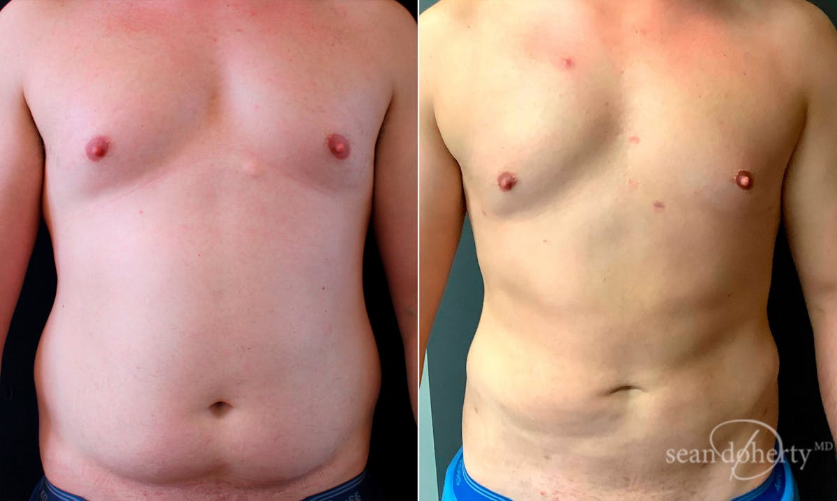 Liposuction and Fat Transfer Before & After Gallery - Patient 906285 - Image 1