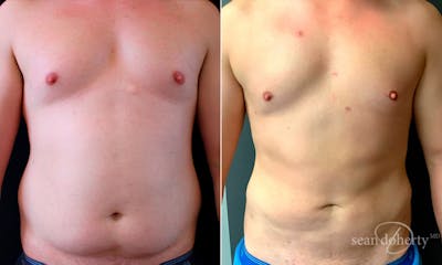 Liposuction and Fat Transfer Before & After Gallery - Patient 906285 - Image 1