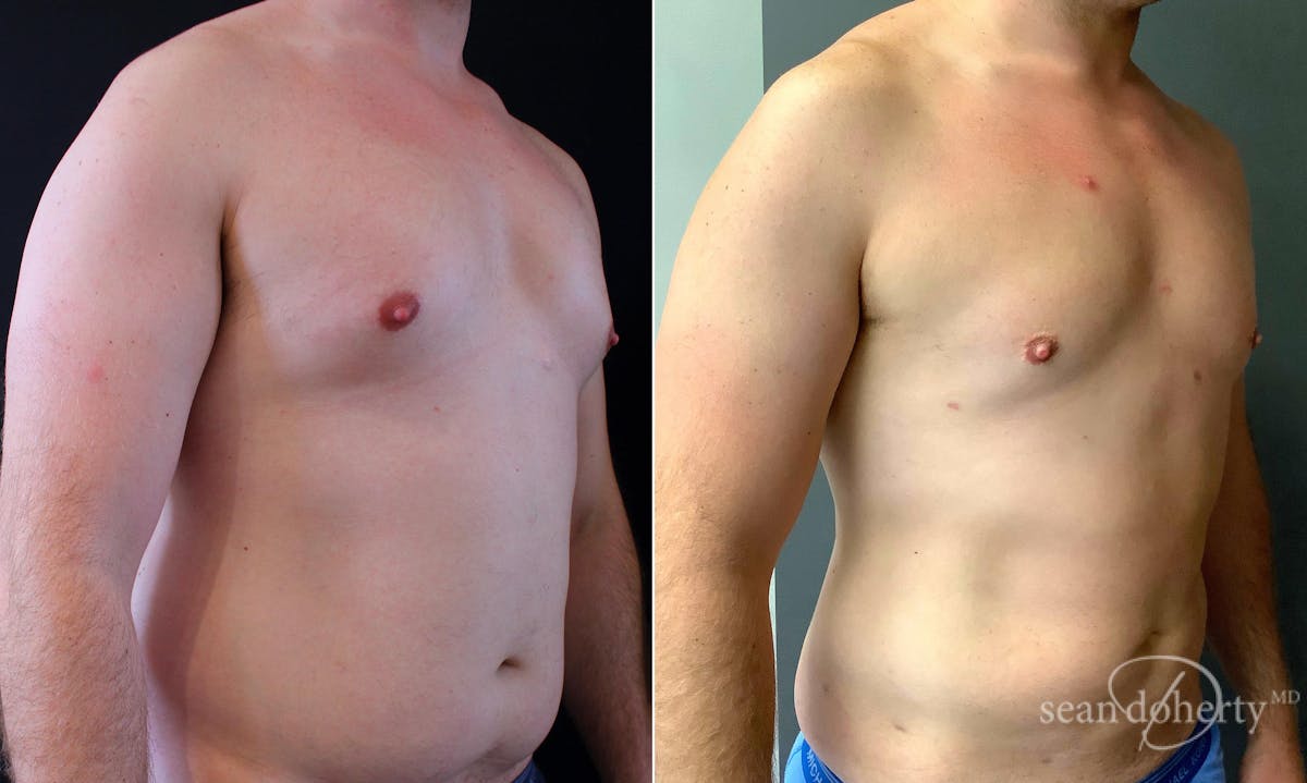 Liposuction and Fat Transfer Before & After Gallery - Patient 906285 - Image 2