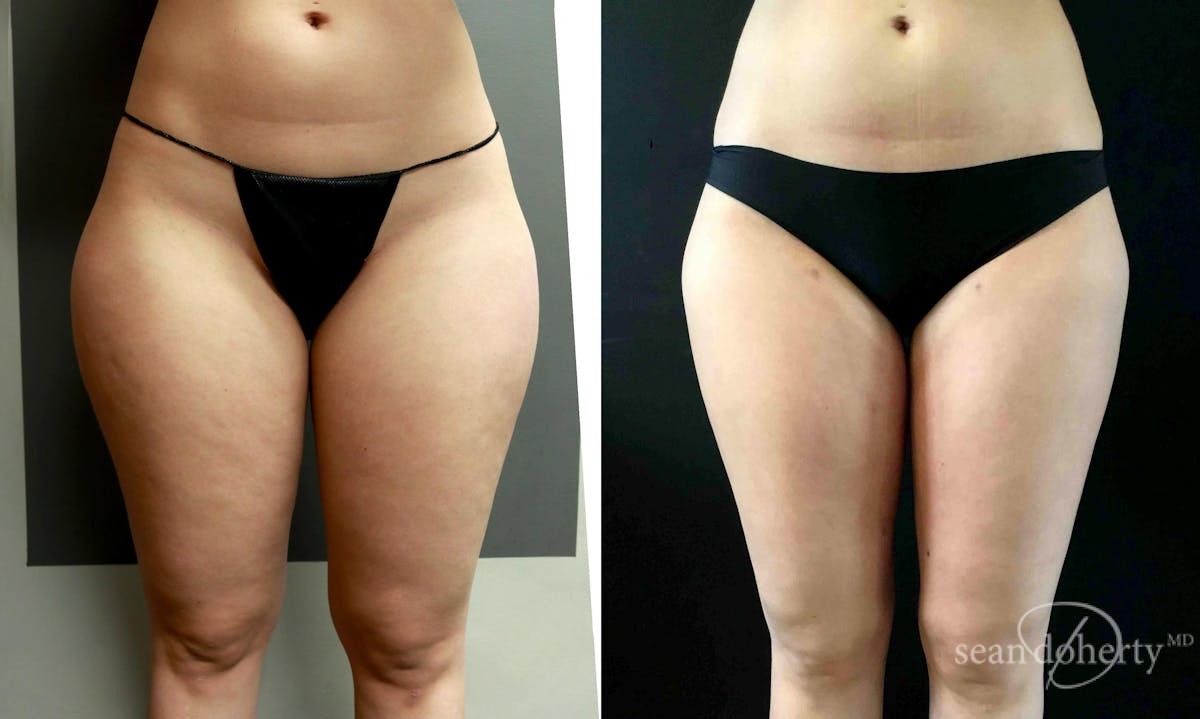 Liposuction and Fat Transfer Before & After Gallery - Patient 309286 - Image 1
