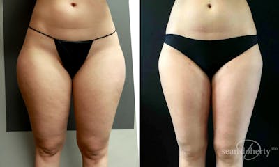 Liposuction and Fat Transfer Before & After Gallery - Patient 309286 - Image 1