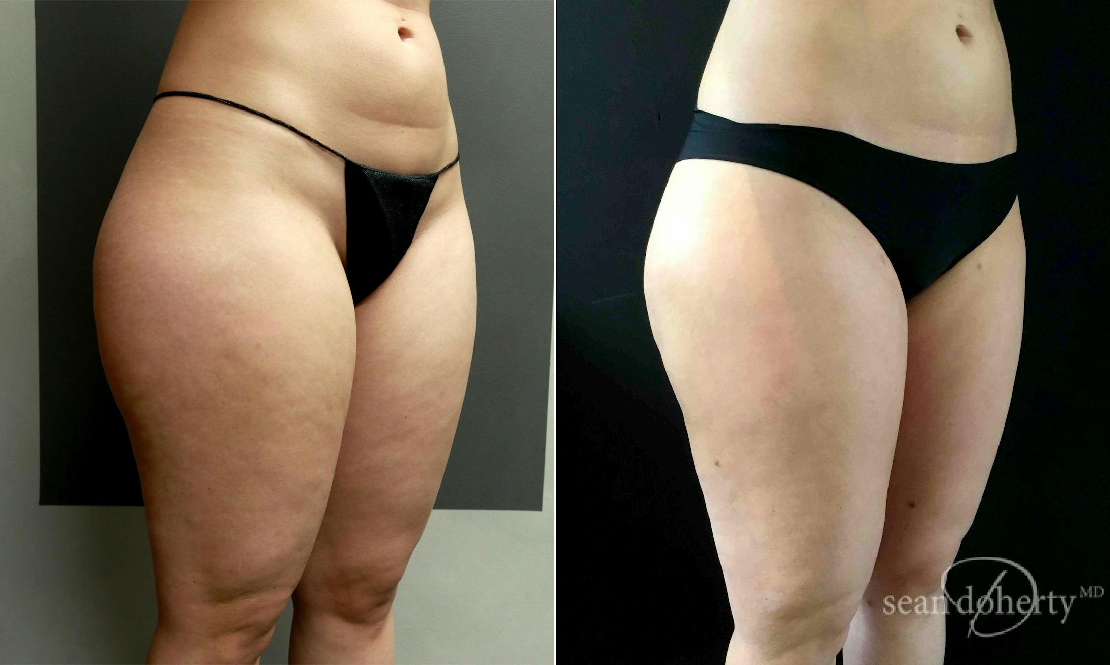 Liposuction and Fat Transfer Before & After Gallery - Patient 309286 - Image 2