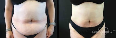 Liposuction and Fat Transfer Before & After Gallery - Patient 128216 - Image 1