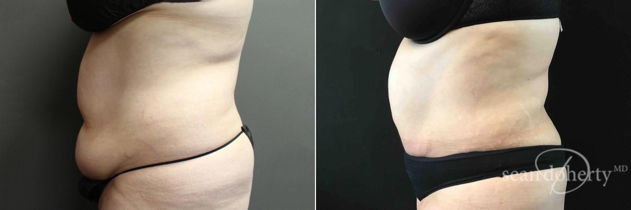 Liposuction and Fat Transfer Before & After Gallery - Patient 128216 - Image 3