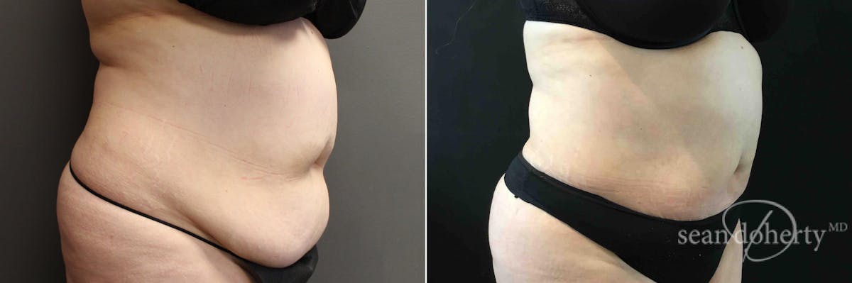 Liposuction and Fat Transfer Before & After Gallery - Patient 128216 - Image 2