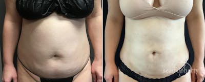 Liposuction and Fat Transfer Before & After Gallery - Patient 137410 - Image 1