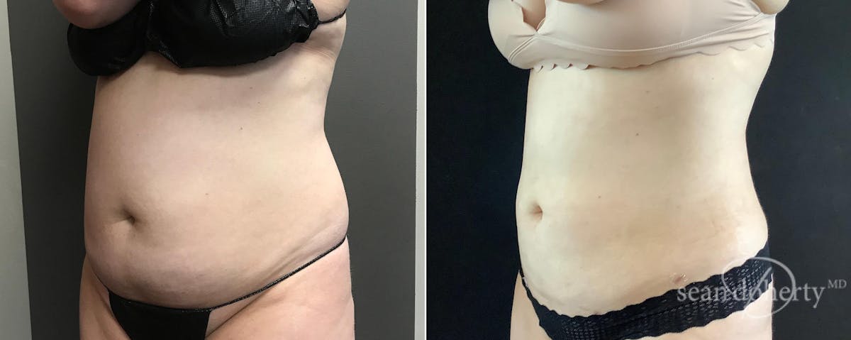 Liposuction and Fat Transfer Before & After Gallery - Patient 137410 - Image 2