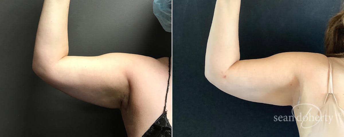 Liposuction and Fat Transfer Before & After Gallery - Patient 137410 - Image 4