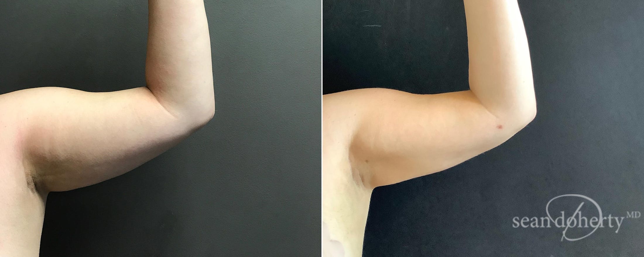 Liposuction and Fat Transfer Before & After Gallery - Patient 137410 - Image 3
