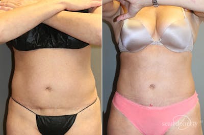 Liposuction and Fat Transfer Before & After Gallery - Patient 181472 - Image 1