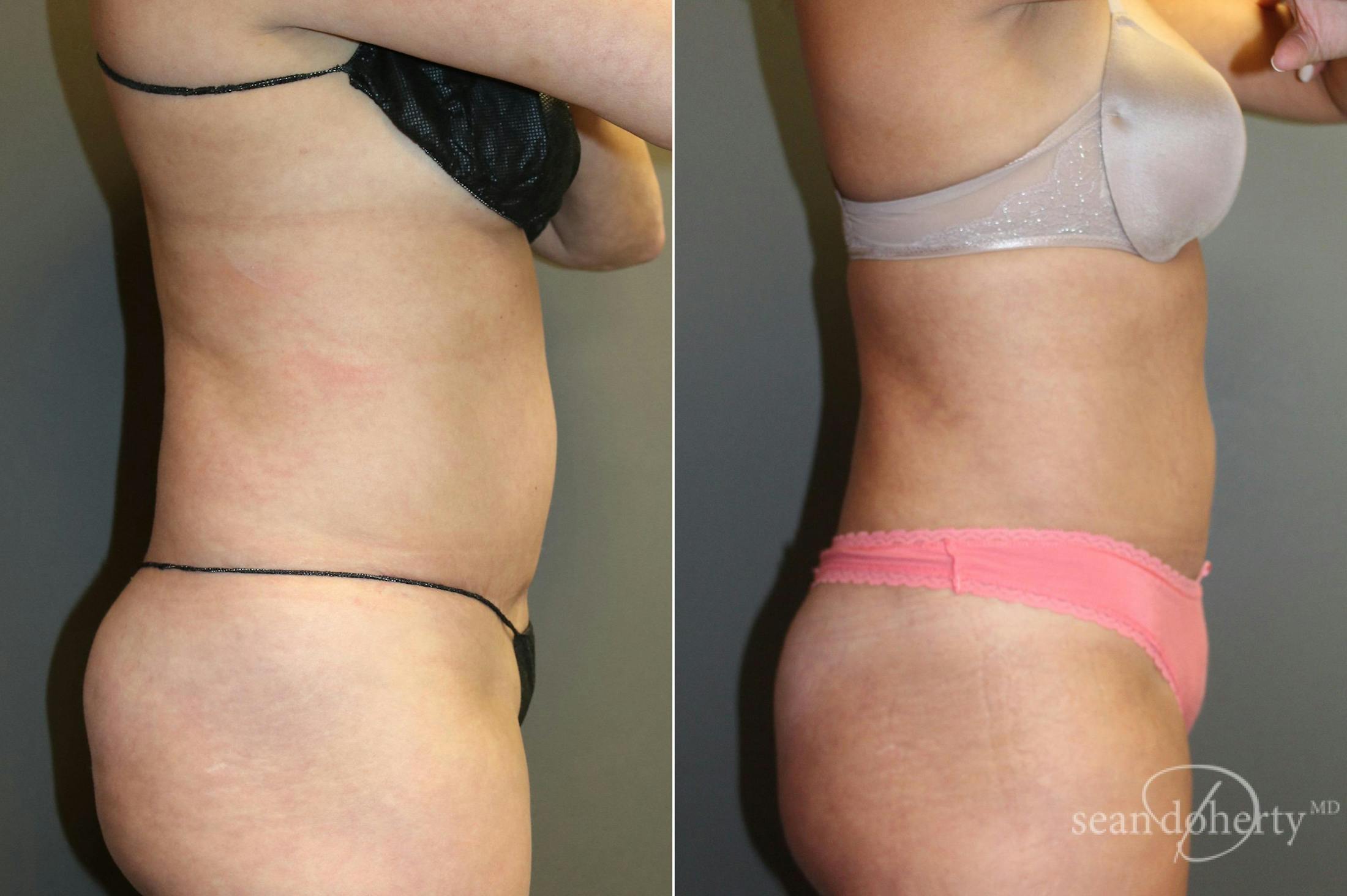 Liposuction and Fat Transfer Before & After Gallery - Patient 181472 - Image 3