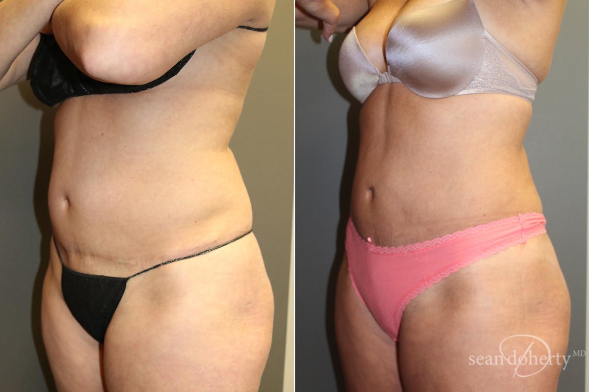 Liposuction and Fat Transfer Before & After Gallery - Patient 181472 - Image 2